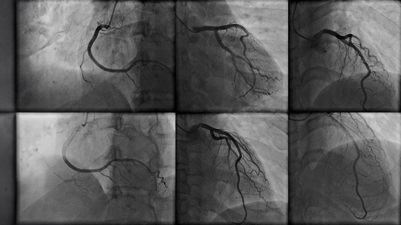 AI Augments Cath Lab to Predict Outcomes