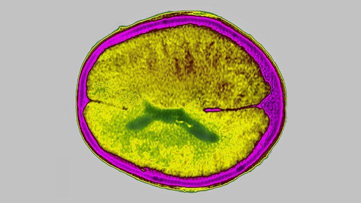 Brain Edema Risk May Be Lower With Modified Donanemab Dosing