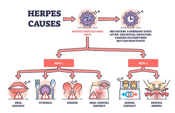 TBI May Reactivate Herpes Virus Leading to Neurodegeneration