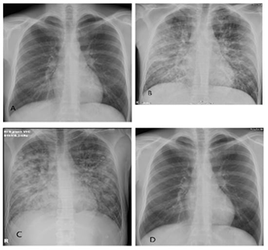 Hantavirus pulmonary syndrome: the infection that killed Betsy Arakawa, Gene Hackman’s wife