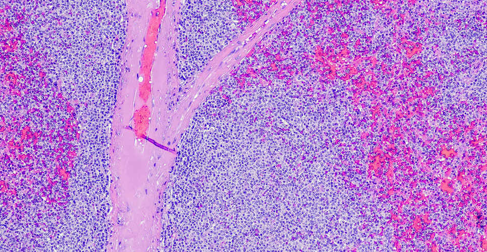 What is mantle cell lymphoma? The ‘rare and fast-moving’ cancer explained