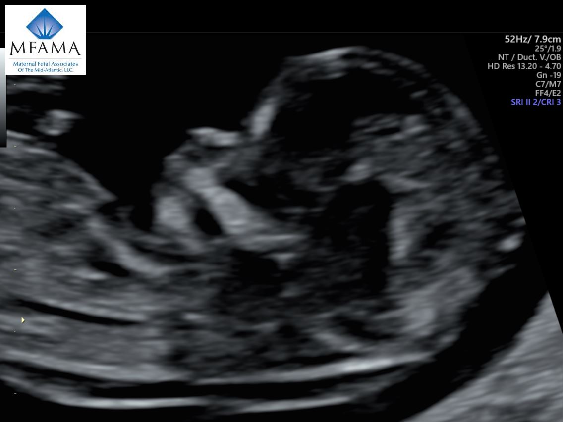 Ultrasound and Maternal Data Predict Prolonged NICU Stay