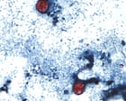 US outbreak of parasite causing ‘watery diarrhea’ rises to more than 2,800 cases