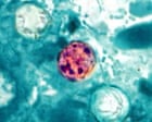 Cyclospora outbreaks causing diarrhea in US expected to continue through August