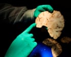 New study estimates 75% of deceased ex-NFL players had brain disease CTE